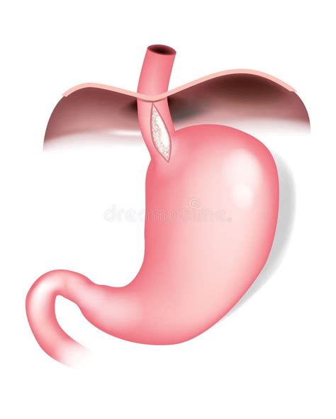 Cardiomyotomy Stock Illustrations – 1 Cardiomyotomy Stock Illustrations, Vectors & Clipart ...