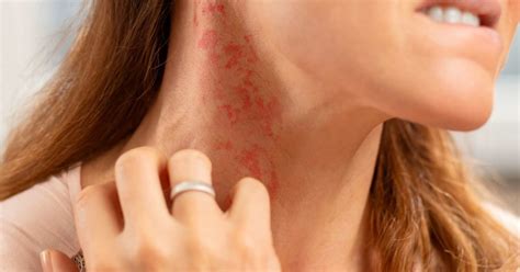 Types of skin rashes that itch and spread - realvir