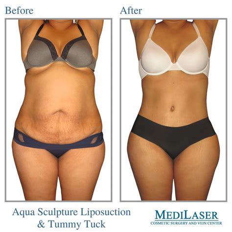 Tummy Tuck and Liposuction Before and After - Medilaser Surgery and Vein Center