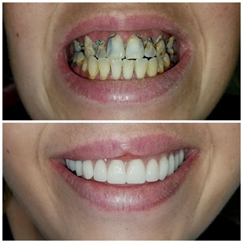 Dentures Before And After Pictures - KeanaSerina