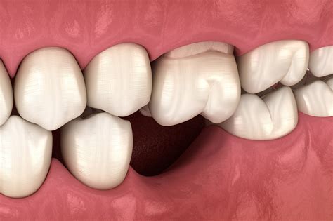 Tooth and Bone Loss | Arkansas Periodontal and Implant Associates