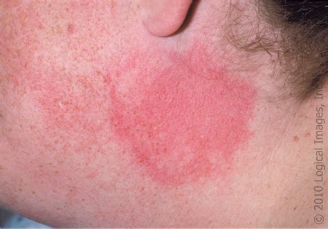 Urticaria: Evaluation and Treatment | AAFP