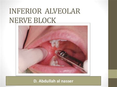 Mandibular Anesthesia : Inferior alveolar nerve block