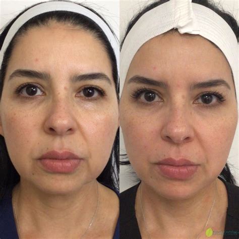 Best Treatments for Ozempic Face Aging and Butt Fat Loss - Reston Dermatology + Cosmetic Center