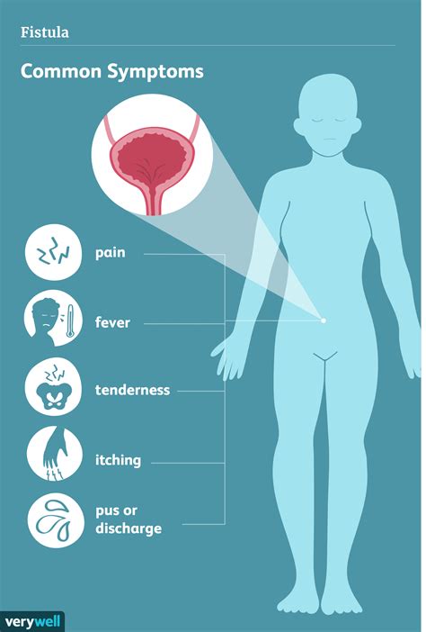 Fistula: Causes, Symptoms, Types, and Treatment