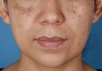 ZO® Multi-Therapy Hydroquinone System | Before and After | Pikeville ...