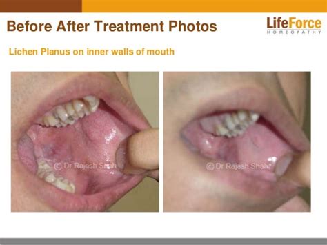 Oral Lichen Planus Photos: Before and After Treatment Pictures of Mouth LP Patients