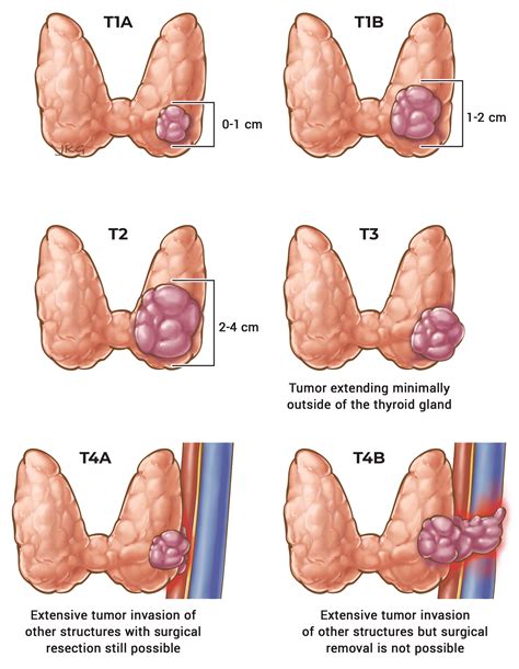 Initial Staging & Response to Therapy ‣ Differentiated Thyroid Cancer