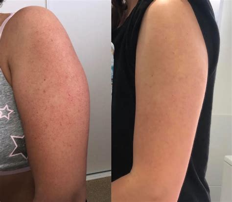 Keratosis Pilaris Before And After