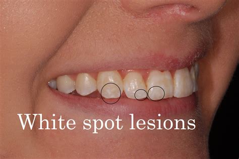 White Spots On Teeth Before And After