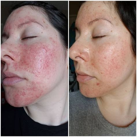 Experiences with Metronidazole/Metrogel? : r/Rosacea