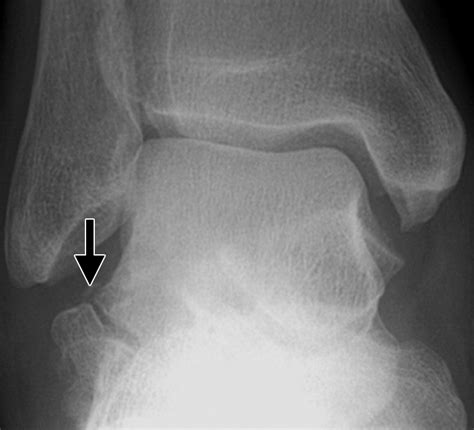 Talar Fractures and Dislocations: A Radiologist’s Guide to Timely Diagnosis and Classification ...