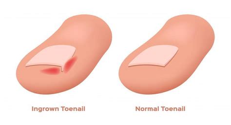 How to Prevent an Ingrown Toenail: Premier Foot & Ankle: Podiatrists