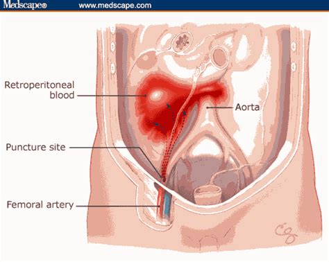 Retroperitoneal Hematoma: 10 Unbelievably Alarming Facts | Thrombocytes