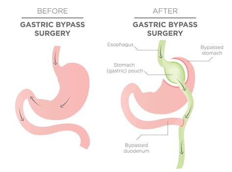 Gastric Bypass Surgery & Cost - The Surgical Weight Loss Centre