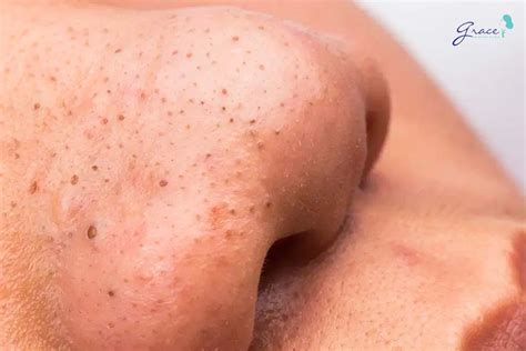 Blackhead removal - Dermatologist tips and advices