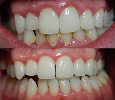 Dental Scaling (Before & After) - GlobalDentalPro