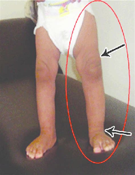 Hemihyperplasia definition, causes, symptoms, diagnosis & treatment