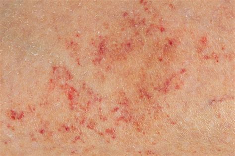 Petechiae: Causes, Treatment & When to See a Doctor | MyVision.org