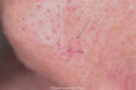 BCC (Basal Cell Carcinoma)