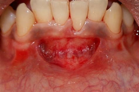 Evaluation of Patient Perceptions After Vestibuloplasty Procedure: A Comparison of Diode Laser ...