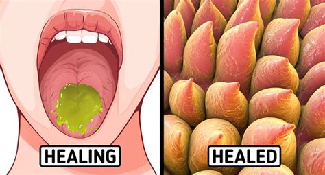 How To Help A Burnt Tongue - Understandingbench16