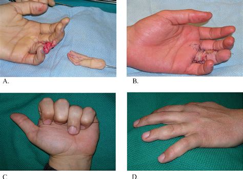 Table 1 from Finger replantations after ring avulsion amputations | Semantic Scholar