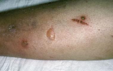 Diabetic Blisters On Legs Pictures - DiabetesWalls