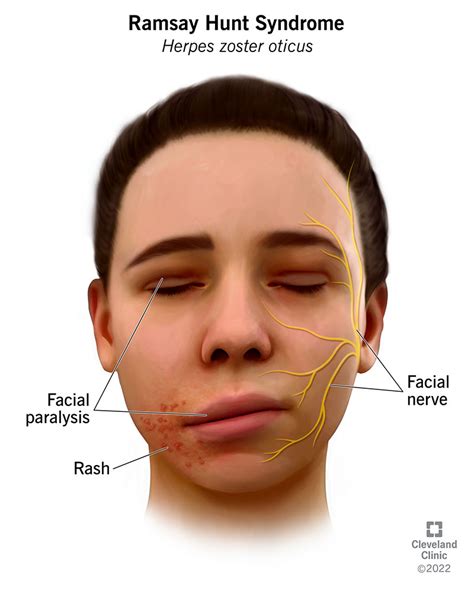 Ramsay Hunt Syndrome (Herpes Zoster Oticus): Causes & Treatment