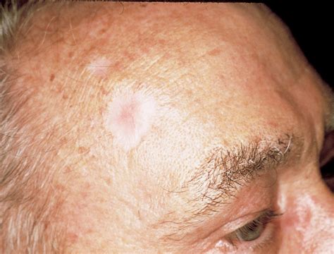 Carcinome basocellulaire - The Skin Cancer Foundation