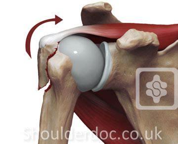 Greater Tubercle Of Humerus