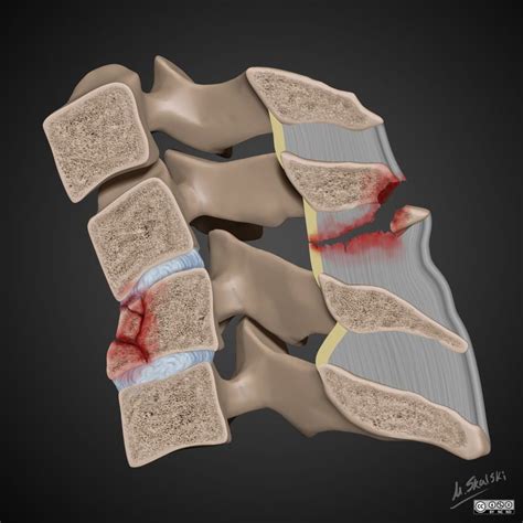 Flexion teardrop fracture (illustration) | Radiology Case | Radiopaedia.org | Radiology ...