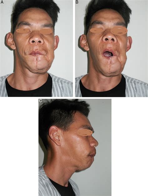 Comprehensive treatment of massive macroglossia due to venous and ...