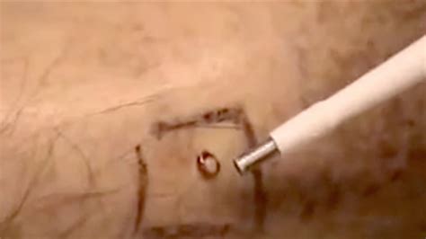 Skin Punch Biopsy Procedure – Johns Hopkins Cutaneous Nerve Laboratory ...