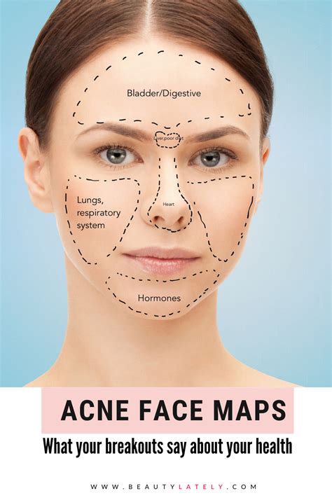 Acne face maps: the reasons behind your breakouts | Face mapping acne, Face acne, Face mapping