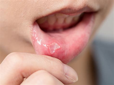 Never Ignore These Early Symptoms Of Oral Cancer - BIGYACK.COM