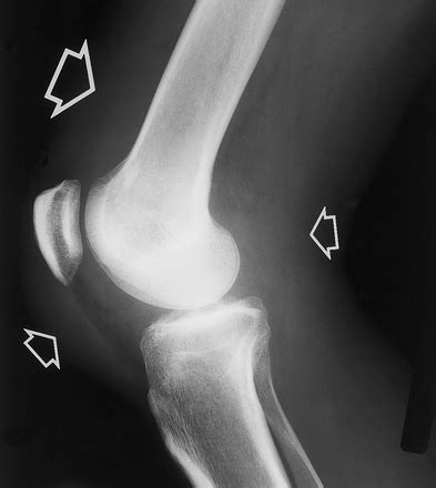 Septic Arthritis - Adult - Trauma - Orthobullets