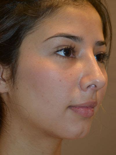 Rhinoplasty Case 2 | Facelift Cosmetic Surgery in Inland Empire