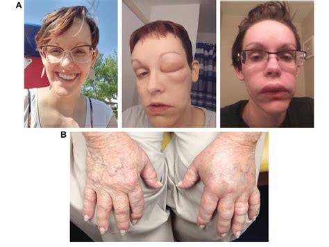 Representative photographs of hereditary angioedema attacks affecting A ...