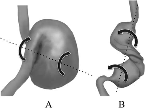 Gastric Volvulus - The Operative Review Of Surgery