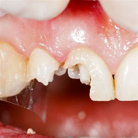 Broken Tooth Extraction Procedure: How It's Done (Steps)