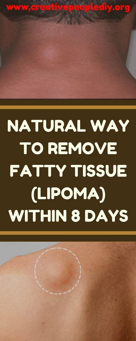 NATURAL WAY TO REMOVE FATTY TISSUE (LIPOMA) WITHIN 8 DAYS | Lipoma removal, How to remove, Fatty