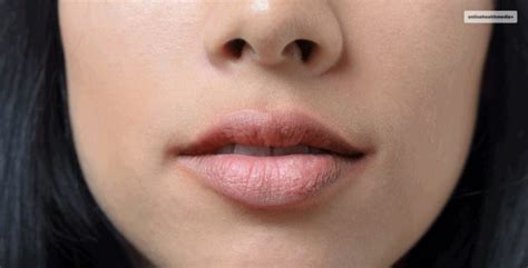 Eczema On Lips: Types, Causes, Symptoms, Treatment, And More!