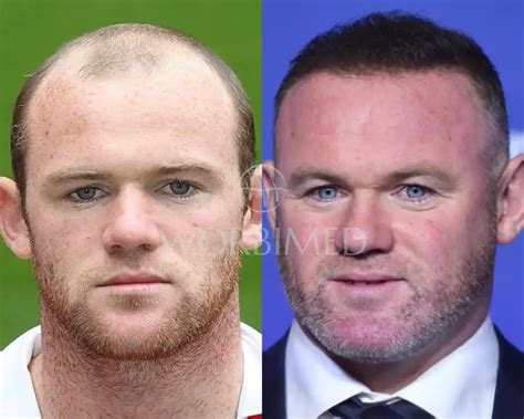 Wayne Rooney Hair Transplant | Before and After