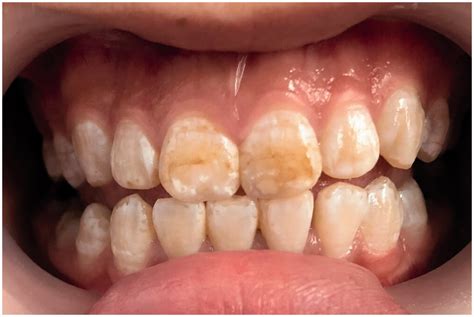 Frontal photograph before whitening treatment. The Tooth Surface Index... | Download Scientific ...