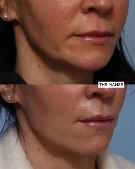 Dermal Filler for Jowls and Marionette Folds - Best Cosmetic Clinic ...