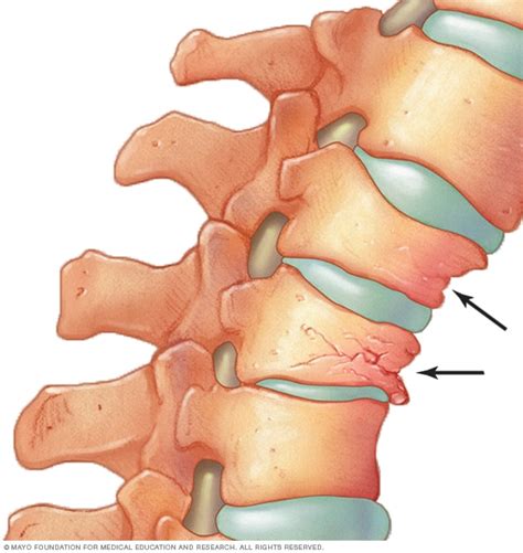 Osteoporosis - Symptoms and causes (2022)