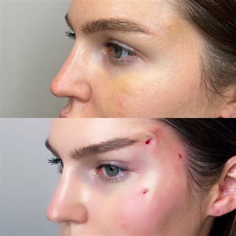 Non-Invasive PDO Brow Thread Lift in Clearwater, Florida