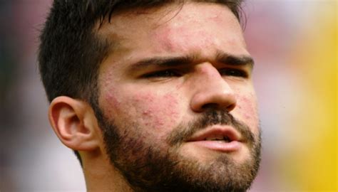 View Alisson Liverpool Without Beard PNG