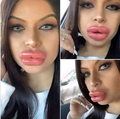 Bad Celebrity Plastic Surgery, Bad Plastic Surgeries, Fake Lips, Big Lips, Lip Surgery, Botox ...